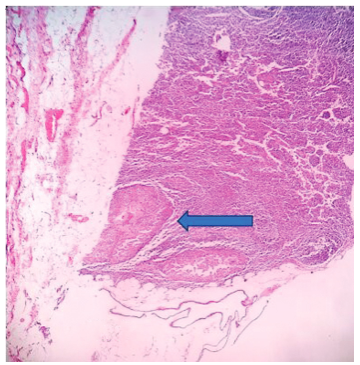 Lymph node showing papillary micrometastasis (blue arrow; hematoxylin and eosin [H&E] stain, 10x).